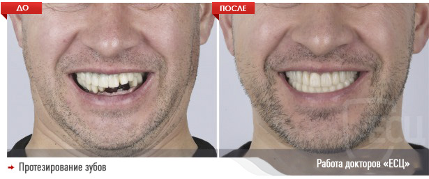 Protezirovanie_1-e1586428536359