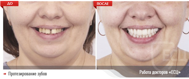 Protezirovanie_2-e1586428544680